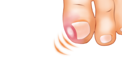 L&rsquo;Ongle incarné …