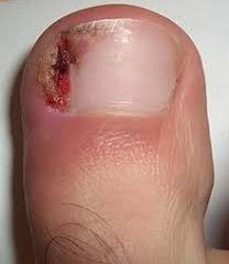 Comment soigner un ongle incarné.