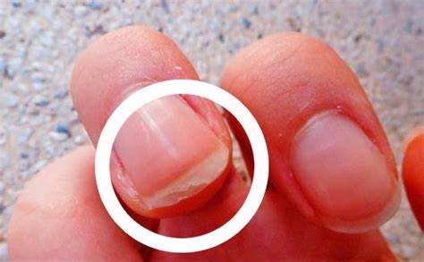 Ongles dédoublés ou cassants : Les solutions
