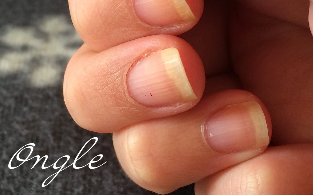 Ongles striés : les causes et les traitements