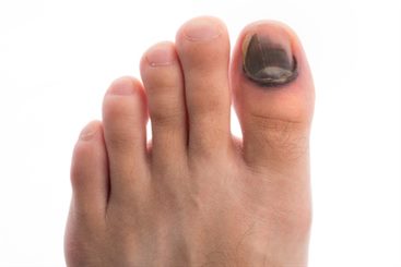 Ongle arraché : Que faire pour le soigner ?