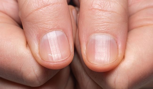 Ongles qui font des vagues : Causes et traitements